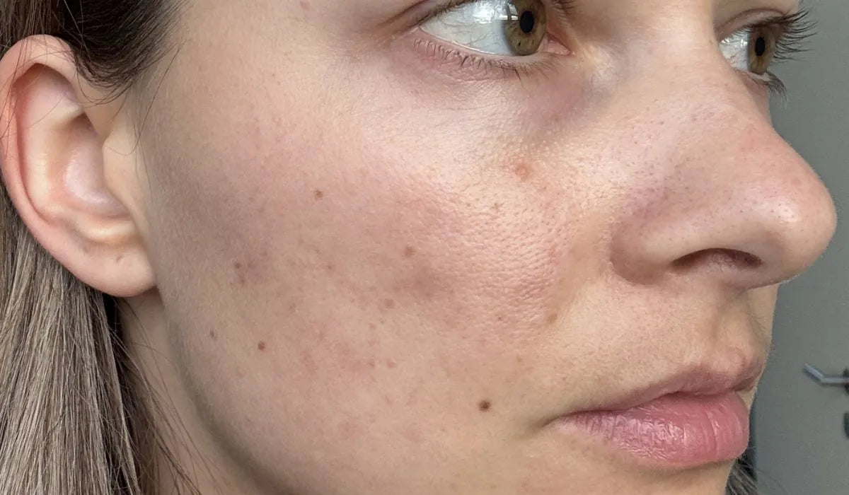 Gesicht einer Frau mit leichten Unreinheiten und sichtbarer Hautstruktur und Pigmentflecken